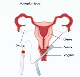 Ovarian PRP for Low AMH