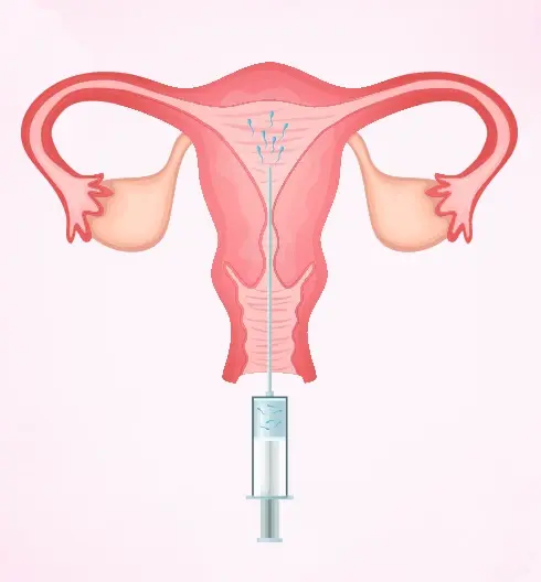 Intrauterine Insemination (IUI)
